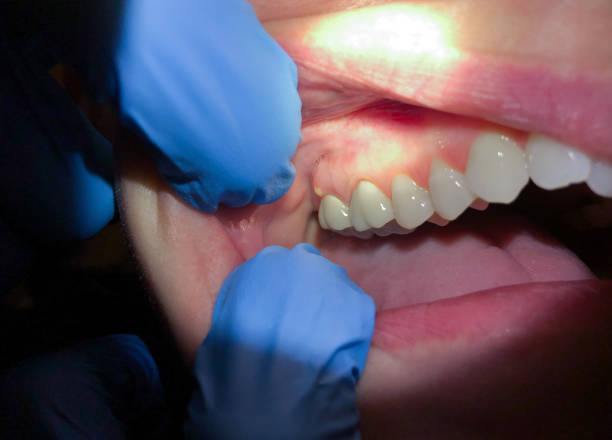Best Emergency Gum Treatment in Pine Air, FL
