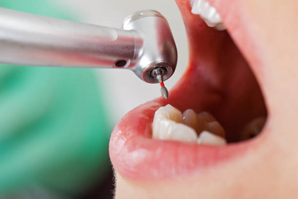 Best Emergency Treatment for Dental Infections or Abscesses in Pine Air, FL
